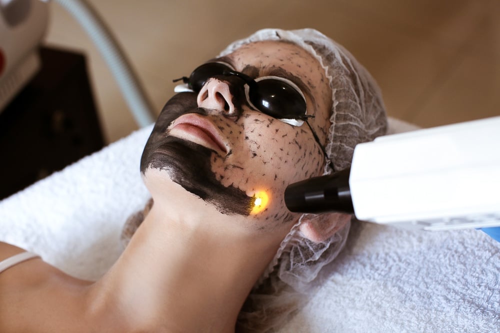 Carbon laser peel (Hollywood peel)